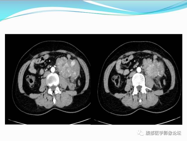 【病例】腹部骨外去分化软骨肉瘤1例CT影响表现 【病例】腹部骨外去分化软骨肉瘤1例CT影响表现