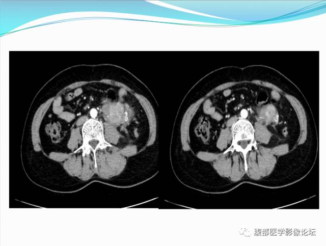 【病例】腹部骨外去分化软骨肉瘤1例CT影响表现 【病例】腹部骨外去分化软骨肉瘤1例CT影响表现