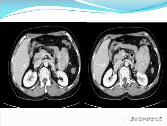 【病例】腹部骨外去分化软骨肉瘤1例CT影响表现 【病例】腹部骨外去分化软骨肉瘤1例CT影响表现
