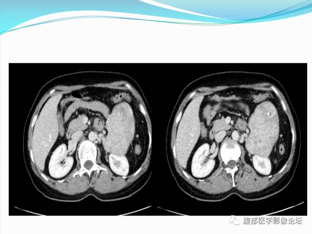 【病例】腹部骨外去分化软骨肉瘤1例CT影响表现 【病例】腹部骨外去分化软骨肉瘤1例CT影响表现