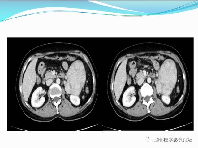 【病例】腹部骨外去分化软骨肉瘤1例CT影响表现 【病例】腹部骨外去分化软骨肉瘤1例CT影响表现