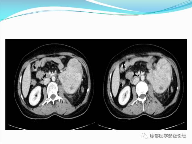 【病例】腹部骨外去分化软骨肉瘤1例CT影响表现 【病例】腹部骨外去分化软骨肉瘤1例CT影响表现