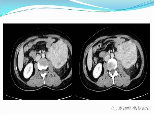 【病例】腹部骨外去分化软骨肉瘤1例CT影响表现 【病例】腹部骨外去分化软骨肉瘤1例CT影响表现