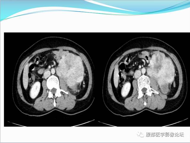 【病例】腹部骨外去分化软骨肉瘤1例CT影响表现 【病例】腹部骨外去分化软骨肉瘤1例CT影响表现