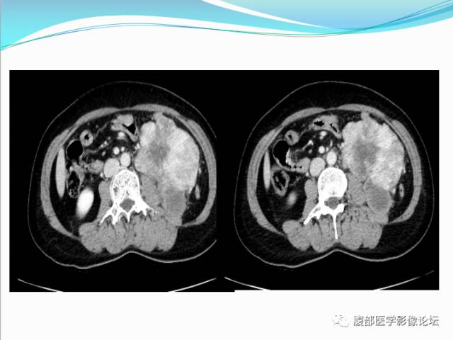 【病例】腹部骨外去分化软骨肉瘤1例CT影响表现 【病例】腹部骨外去分化软骨肉瘤1例CT影响表现