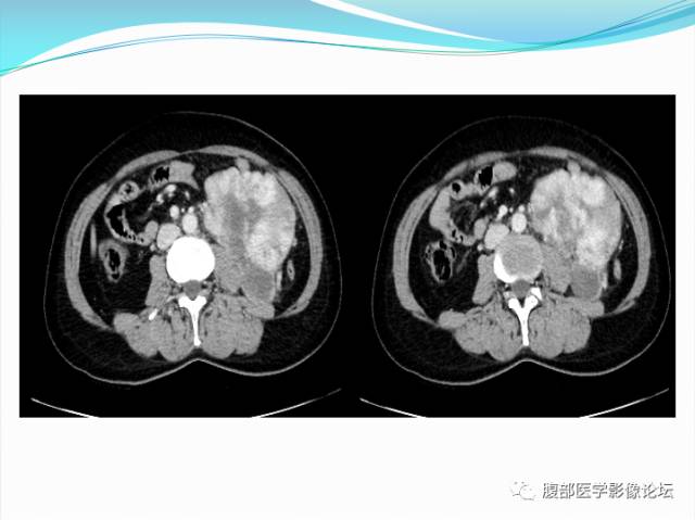 【病例】腹部骨外去分化软骨肉瘤1例CT影响表现 【病例】腹部骨外去分化软骨肉瘤1例CT影响表现