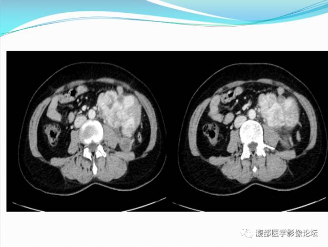 【病例】腹部骨外去分化软骨肉瘤1例CT影响表现 【病例】腹部骨外去分化软骨肉瘤1例CT影响表现