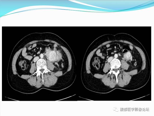 【病例】腹部骨外去分化软骨肉瘤1例CT影响表现 【病例】腹部骨外去分化软骨肉瘤1例CT影响表现