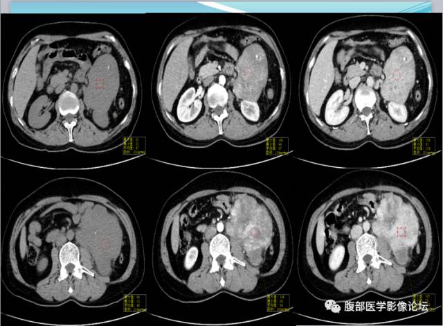 【病例】腹部骨外去分化软骨肉瘤1例CT影响表现 【病例】腹部骨外去分化软骨肉瘤1例CT影响表现