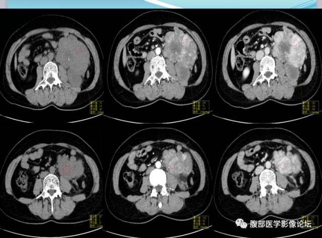 【病例】腹部骨外去分化软骨肉瘤1例CT影响表现 【病例】腹部骨外去分化软骨肉瘤1例CT影响表现