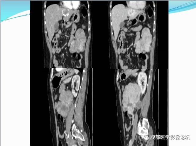 【病例】腹部骨外去分化软骨肉瘤1例CT影响表现 【病例】腹部骨外去分化软骨肉瘤1例CT影响表现