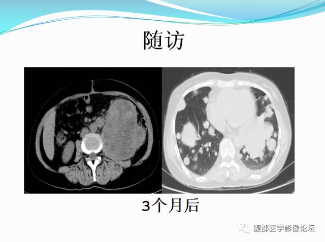 【病例】腹部骨外去分化软骨肉瘤1例CT影响表现 【病例】腹部骨外去分化软骨肉瘤1例CT影响表现