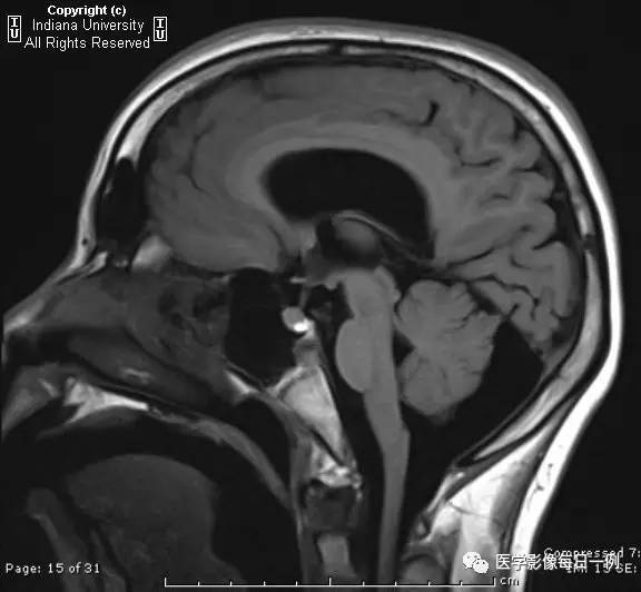 【病例】无脑回畸形1例MR影像表现 【病例】无脑回畸形1例MR影像表现