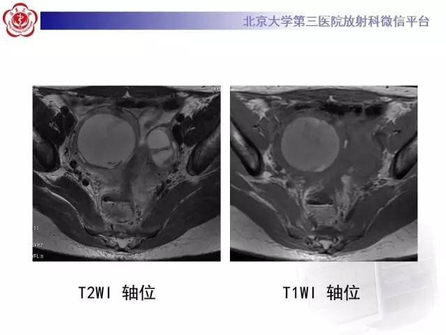 【病例】卵巢巧克力囊肿继发感染1例MR影像表现