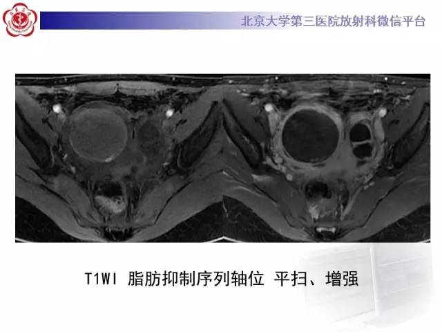 【病例】卵巢巧克力囊肿继发感染1例MR影像表现