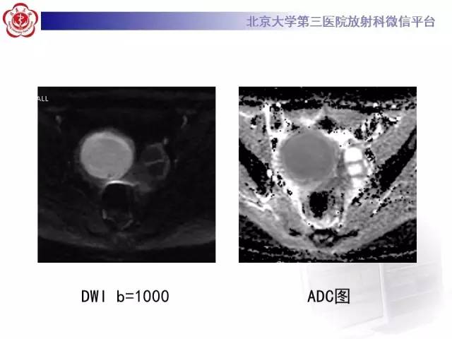 【病例】卵巢巧克力囊肿继发感染1例MR影像表现
