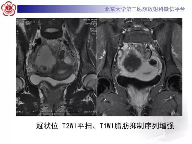 【病例】卵巢巧克力囊肿继发感染1例MR影像表现