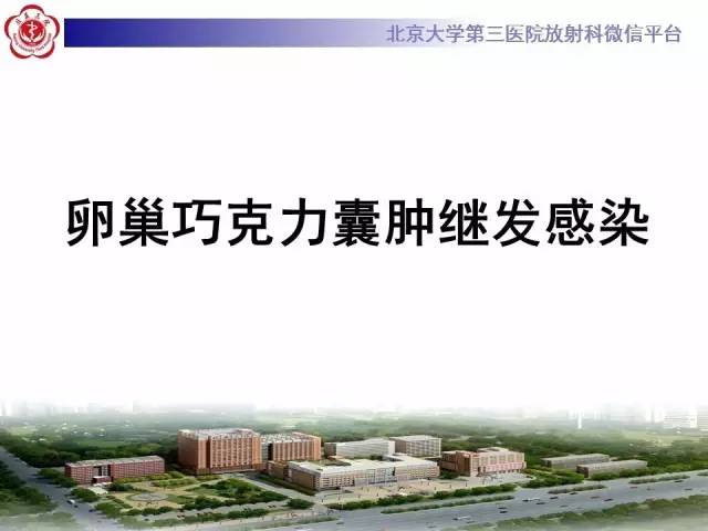 【病例】卵巢巧克力囊肿继发感染1例MR影像表现