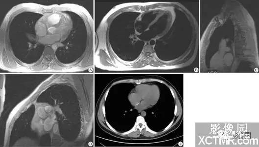 【病例】房间隔缺损MRI/CT一例