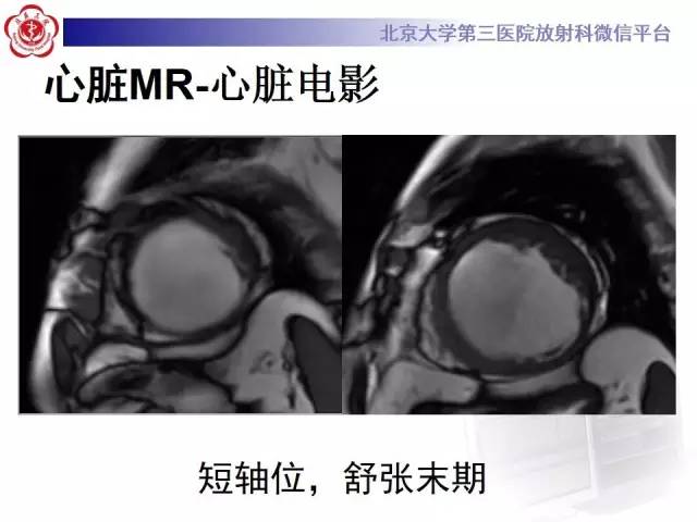 【病例】冠心病心肌梗死伴心尖部室壁瘤形成1例MR