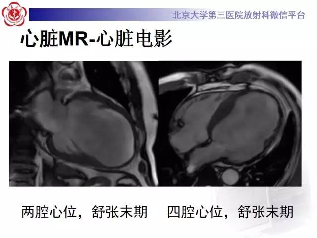 【病例】冠心病心肌梗死伴心尖部室壁瘤形成1例MR