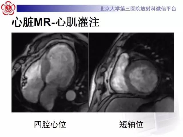 【病例】冠心病心肌梗死伴心尖部室壁瘤形成1例MR