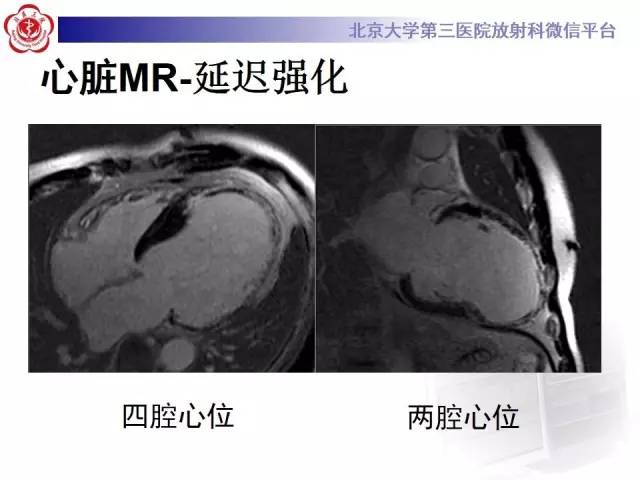 【病例】冠心病心肌梗死伴心尖部室壁瘤形成1例MR