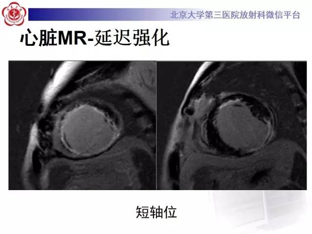 【病例】冠心病心肌梗死伴心尖部室壁瘤形成1例MR