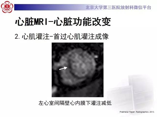【病例】冠心病心肌梗死伴心尖部室壁瘤形成1例MR