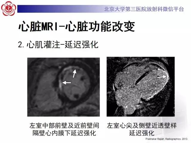 【病例】冠心病心肌梗死伴心尖部室壁瘤形成1例MR