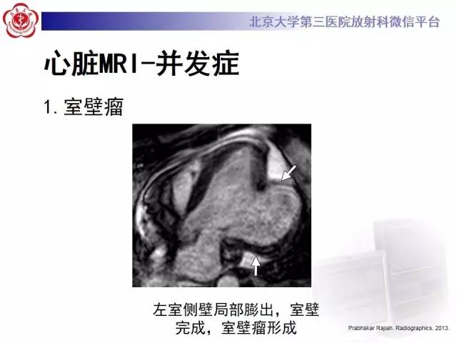 【病例】冠心病心肌梗死伴心尖部室壁瘤形成1例MR
