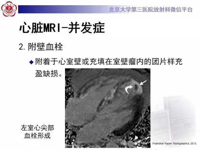 【病例】冠心病心肌梗死伴心尖部室壁瘤形成1例MR