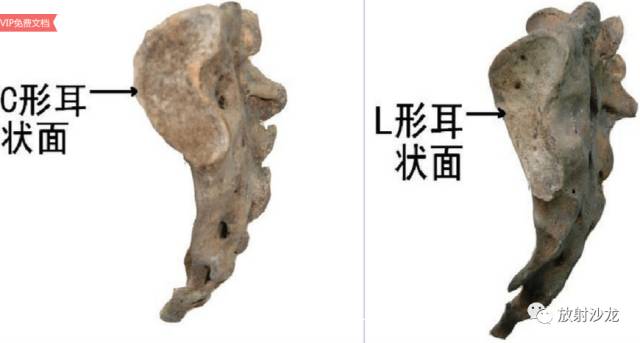 耳状面肥大 耳状面肥大