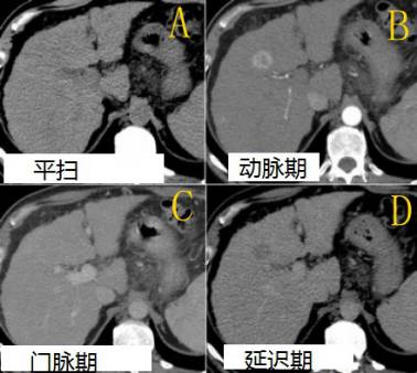 肝脏占位的常见CT征象 肝脏占位的常见CT征象