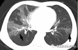 【影像基础】绝不简单的马赛克灌注 【影像基础】绝不简单的马赛克灌注