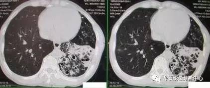 【影像基础】绝不简单的马赛克灌注 【影像基础】绝不简单的马赛克灌注