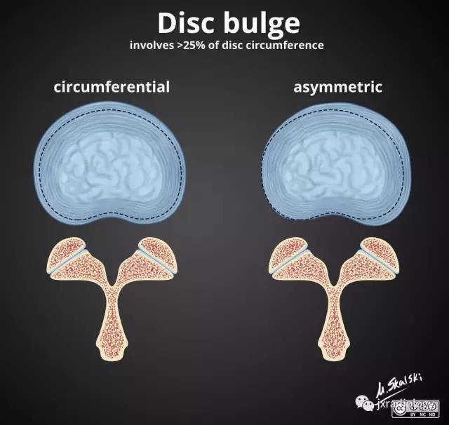 教你用数据判断腰椎间盘的突出、膨出