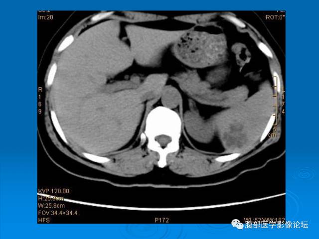 【病例】脾脏淋巴管瘤1例CT影像表现 【病例】脾脏淋巴管瘤1例CT影像表现
