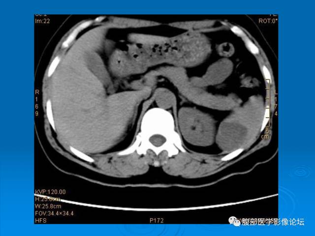 【病例】脾脏淋巴管瘤1例CT影像表现 【病例】脾脏淋巴管瘤1例CT影像表现