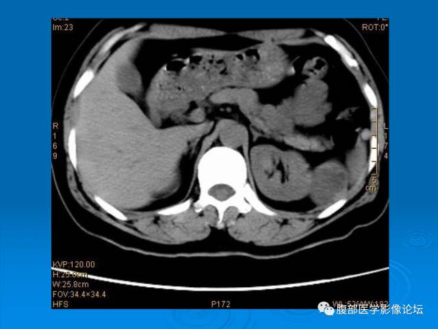 【病例】脾脏淋巴管瘤1例CT影像表现 【病例】脾脏淋巴管瘤1例CT影像表现
