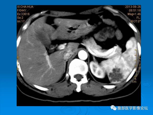 【病例】脾脏淋巴管瘤1例CT影像表现 【病例】脾脏淋巴管瘤1例CT影像表现