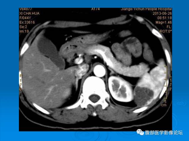 【病例】脾脏淋巴管瘤1例CT影像表现 【病例】脾脏淋巴管瘤1例CT影像表现