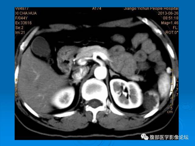 【病例】脾脏淋巴管瘤1例CT影像表现 【病例】脾脏淋巴管瘤1例CT影像表现