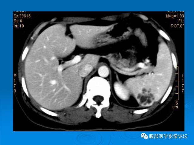 【病例】脾脏淋巴管瘤1例CT影像表现