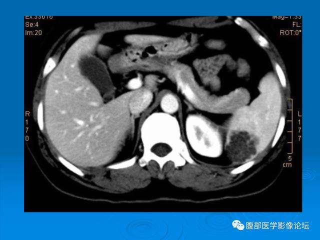 【病例】脾脏淋巴管瘤1例CT影像表现 【病例】脾脏淋巴管瘤1例CT影像表现