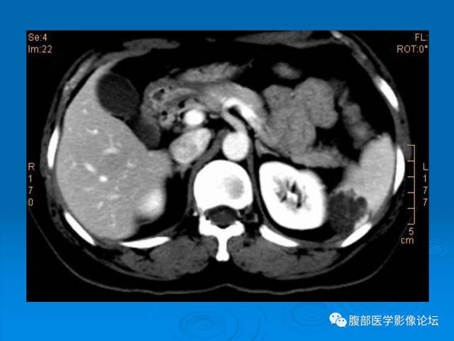 【病例】脾脏淋巴管瘤1例CT影像表现 【病例】脾脏淋巴管瘤1例CT影像表现