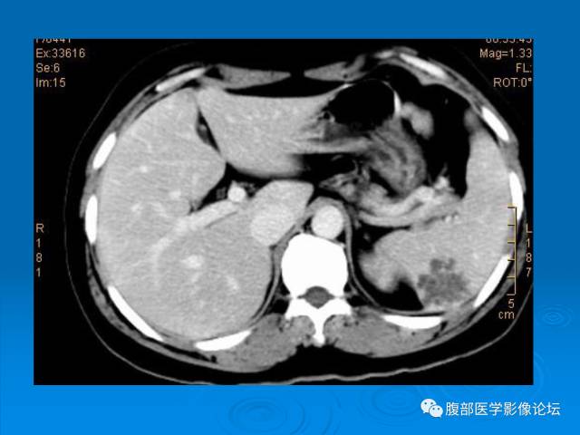 【病例】脾脏淋巴管瘤1例CT影像表现 【病例】脾脏淋巴管瘤1例CT影像表现