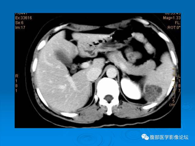 【病例】脾脏淋巴管瘤1例CT影像表现 【病例】脾脏淋巴管瘤1例CT影像表现