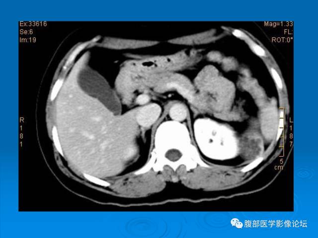【病例】脾脏淋巴管瘤1例CT影像表现 【病例】脾脏淋巴管瘤1例CT影像表现