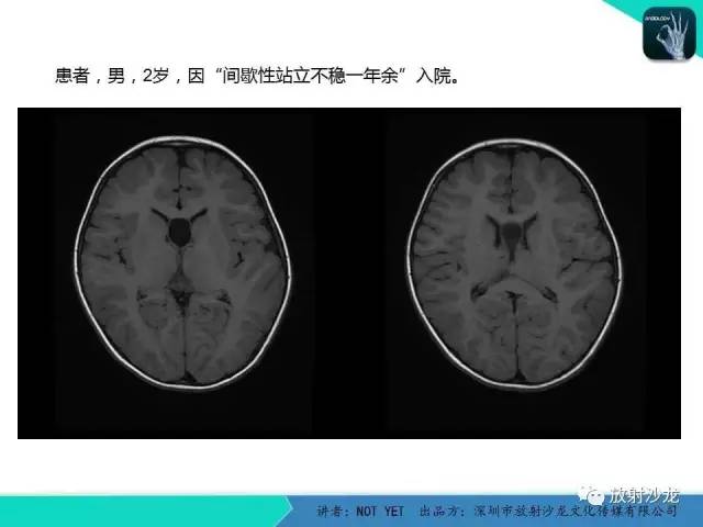 【病例】节细胞胶质瘤1例MR影像表现